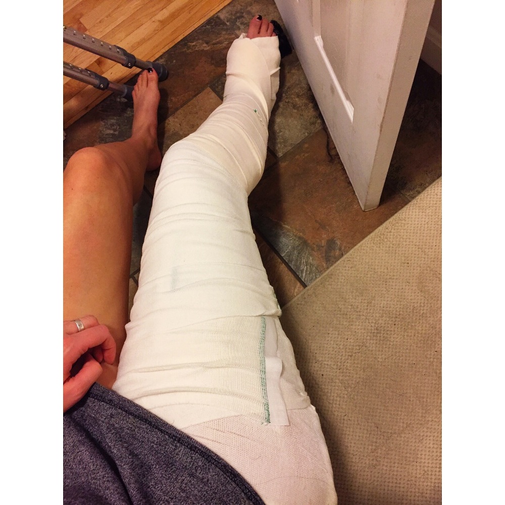 Broken leg!
